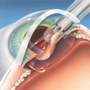 cataracts