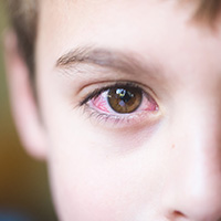 conjunctivitis-pink-eye