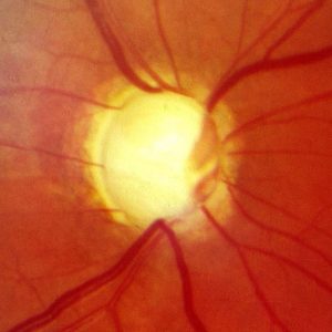 glaucoma