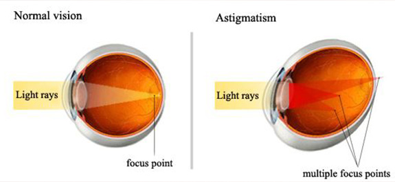 Astigmatism