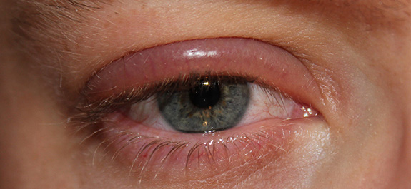 Blepharitis