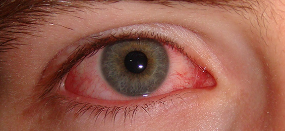 Pink Eye